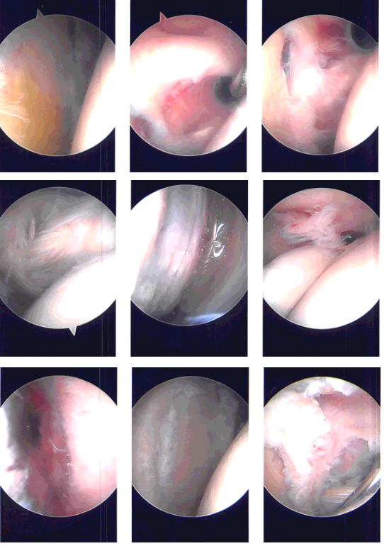 Intraoperative Arthroscopy Images