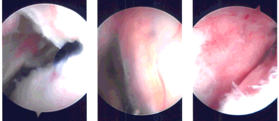 Intraoperative Arthroscopy Images
