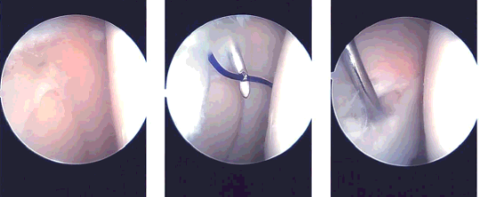 Intraoperative images