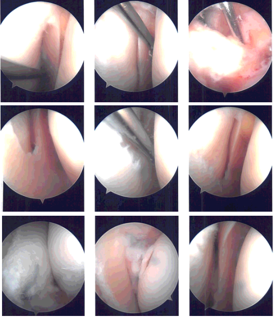 Intraoperative Arthroscopy Images