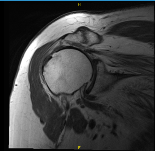 MRI-3T right shoulder non-contrast
