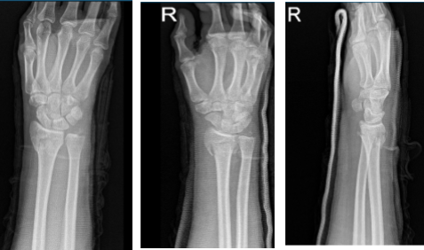 MRI of the wrist