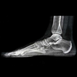 Foot Xray