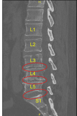 Disc bulge and facet arthropathy